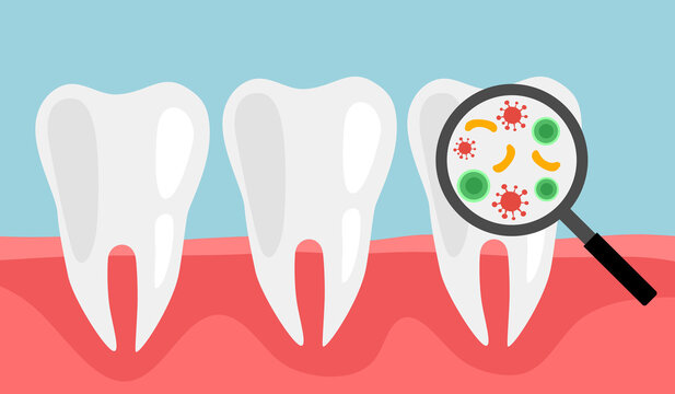 Magnifying Glass Tooth Bacteria Concept Vector Illustration. Dental Health Problem.