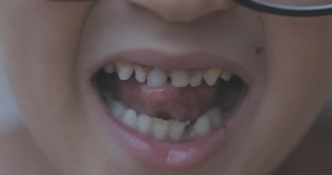 child touches a swinging tooth with his tongue, Shaking tooth