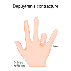 Dupuytren's contracture. Dupuytren's disease in left hand.
