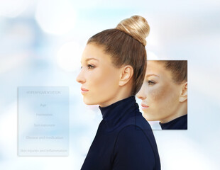 Hyperpigmentation: chloasma, melasma , age spots,Post-inflammatory hyperpigmentation.Hyperpigmentation removal