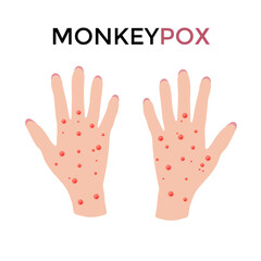 monkey pox hands rash. virus bacterium. epidemic.