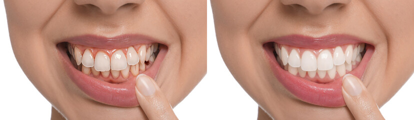 Collage with photos of young woman before and after dental treatment on white background, closeup....