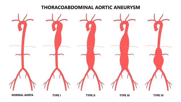 Heart Blood Vessel Clots Aortic Arch Damage And Vein Dilated Left Aorta Root Bulge Of Turner Marfan Syndrome Chest Disorder Attack Stroke Graft For Pain With Hernia High Stent Open Renal Kidney