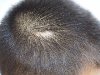 Scar on skin head in kid boy use for fue hair transplant concept. closeup photo, blurred.