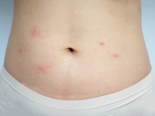 Stomach redness caused by skin allergy, insect bites, mosquito bites, health concepts and medical. closeup photo, blurred.