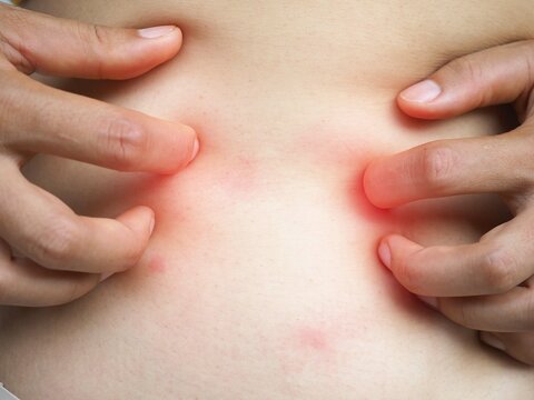 Asian woman scratching her stomach. caused by hives, insect bites, health care concepts. closeup photo, blurred.