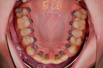 lingual orthodontics