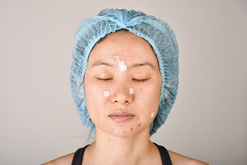 Facial skin problem, Acne disease in adult, Close up woman face with whitehead pimples, Oily greasy...