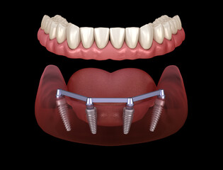 Mandibular prosthesis with gum All on 4 system supported by implants.  Medically accurate 3D illustration of human teeth and dentures concept