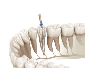 Endodontic root canal treatment process. Medically accurate tooth 3D illustration. - 514937934