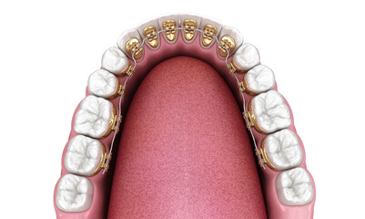 Healthy Teeth with gold braces, white style concept, dental 3D illustration