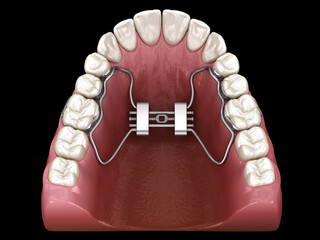 Rapid Palatal Expansion. Medically accurate tooth 3D illustration - 514938396