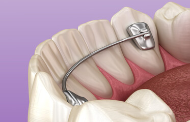 Retainers dental installed after braces treatment, Medically accurate dental 3D illustration