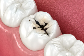 Fototapeta na wymiar Molar teeth damaged by caries. Medically accurate tooth 3D illustration.