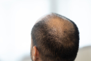 Close up man hair loss. Young man itchy head There is a fungus on the scalp dandruff red rash be scratched head to bring relief. Need to consult a doctor. Hair problems hair loss.