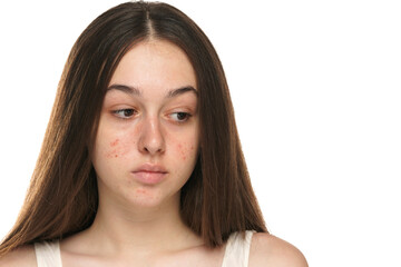 beautiful young women with problematic skin