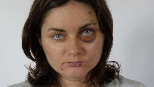 Large real bruise hematoma under the eye of a young woman, purple bruise. Broken lip and forehead wound. terrified face of domestic violence victim close-up white background.