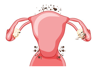 Obraz premium Endometriosis 2 stage Female reproductive system pain pcos tissue cancer uterus. Human anatomy location flat style icon. Cross section vector illustration Realistic color concept isolated on white