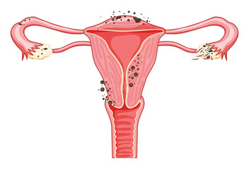 Obraz na płótnie Canvas Endometriosis stages Female reproductive system pain uterus. Front view. Human anatomy internal organs location scheme flat style icon vector illustration Realistic flat color concept isolated white