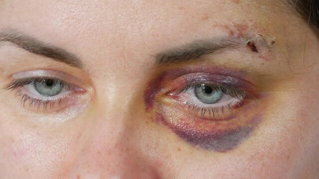 Large real bruise hematoma under the eye of a young woman, purple bruise. Broken lip and forehead wound. terrified face of domestic violence victim close-up white background.