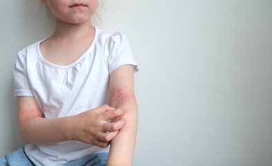 The child scratches atopic skin. Dermatitis, diathesis, allergy on the child's body.
