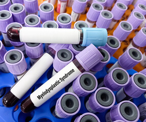 Blood sample for Myelodysplastic syndrome test, close and focus  view.