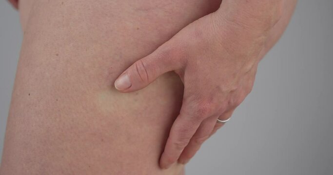 Macro close up shot of woman squeezing thigh with cellulite mark. Gimbal