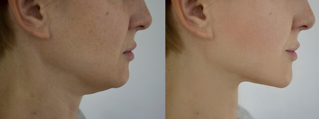 Woman face wrinkles before and after double chin treatment