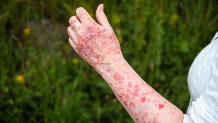 Elderly woman suffering from a severe case of sun allergy on her arm. Typically the skin becomes itchy and red, and when exposed to sunlight for too long rashes and blisters develops.
 - obrazy, fototapety, plakaty