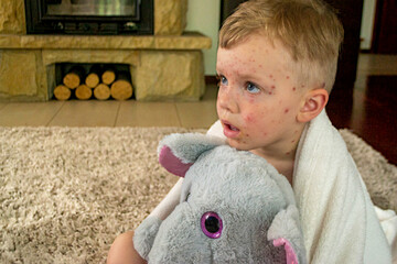 Natural vaccination. Contagious disease. Sick child with chickenpox. Varicella virus or Chickenpox...
