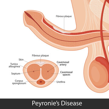 Peyronie disease. male reproductive system. penis medical vector illustration.