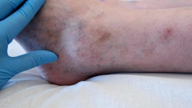 Varicose veins on a male leg. 4K footage