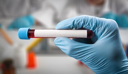Blood sample of patient for test in laboratory. doctor with Blood tube for Sodium test in lab