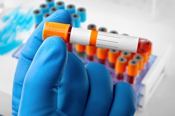 Suspected adenovirus as a culprit in childhood hepatitis of unknown origin. Blood test