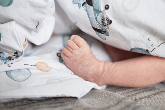 Close up photo of Newborn baby feet with flaky dry skin. Infant after born with wrinkled and cracked skin on foot