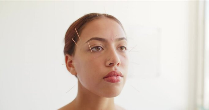 Young woman with acupuncture needles in her head and face at a beauty spa. Beautiful female day spa client dry needling. Alternative treatment for health, beauty, skincare and anti aging