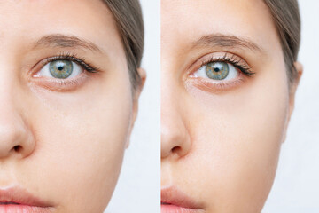 Cropped shot of young caucasian woman's face with drooping upper eyelid before and after plastic surgery isolated on white background. Result of blepharoplasty. Changing the shape, cut of the eyes