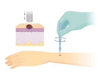 Use the Biopsy punches tool to pierce small tissue of skin layer for diagnosis and skin cancer treatment. Illustration about medical techniques and equipment.