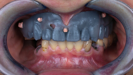 printed mock-up of the future prosthesis on the upper jaw before implantation © Dental Pro Content