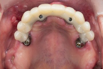 installed dental prosthesis of the upper jaw with a titanium bar, distal view through the mirror © Dental Pro Content