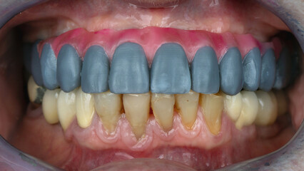 fitting a model of the prosthesis of the upper jaw with a red gum in the oral cavity © Dental Pro Content