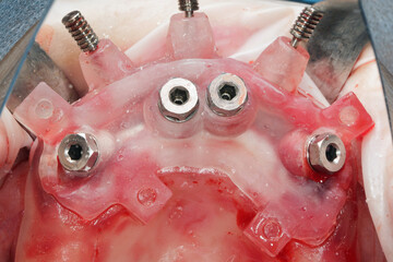 installed four dental implants in a collapsible surgical template of the upper jaw