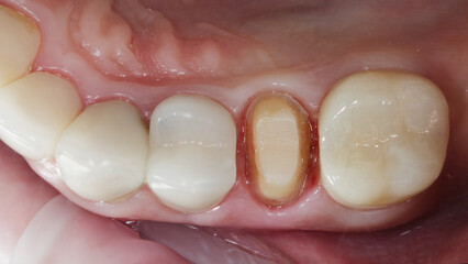 A perfectly prepared posterior tooth is waiting for a ceramic crown to be bonded