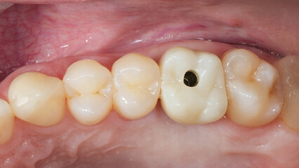 installed dental crown of the chewing tooth before closing the screw shaft