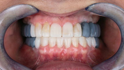 Obraz premium mock-up of prosthesis bridges for posterior teeth in the jaw bite