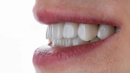 Obraz premium smile with ceramic veneers, side view on a white background