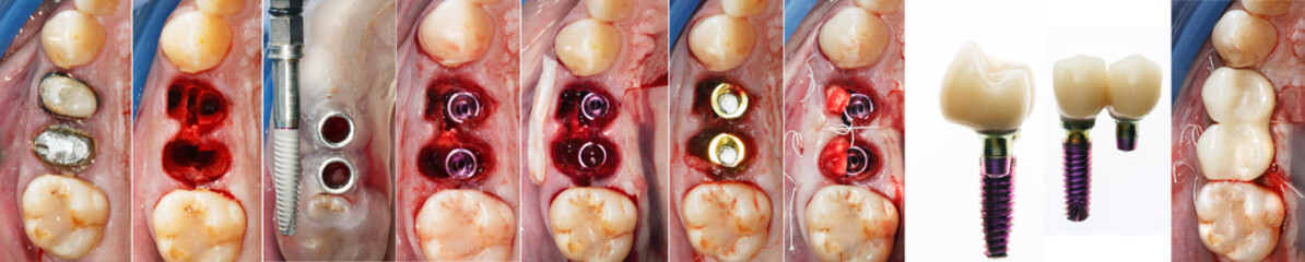 dental collage of tooth extraction, implantation, installation of shapers and prosthetics