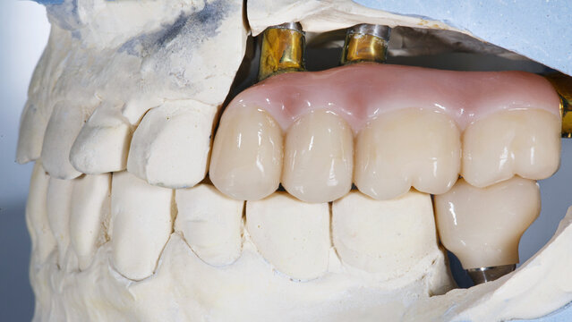 dental bridge prosthesis with a gum on a titanium beam and one crown on the model in the occlusion