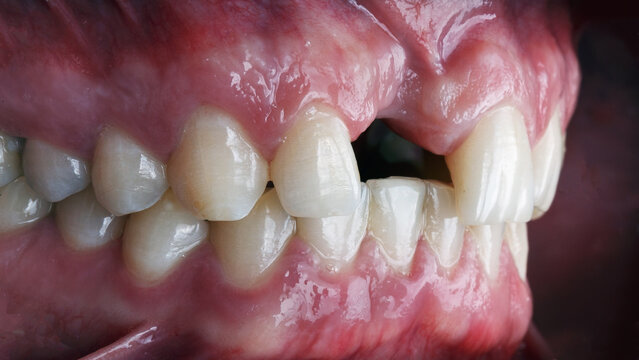 excellent dental shot of missing central tooth and lack of bone
