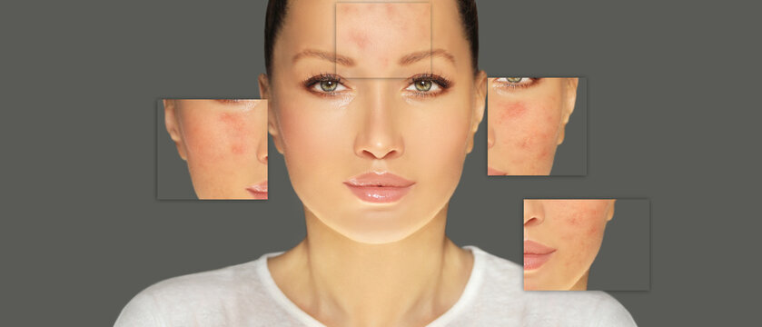 Acne,Skin Concern,blemish-prone Skin And Acne, Rosacea,different Types Of Acne